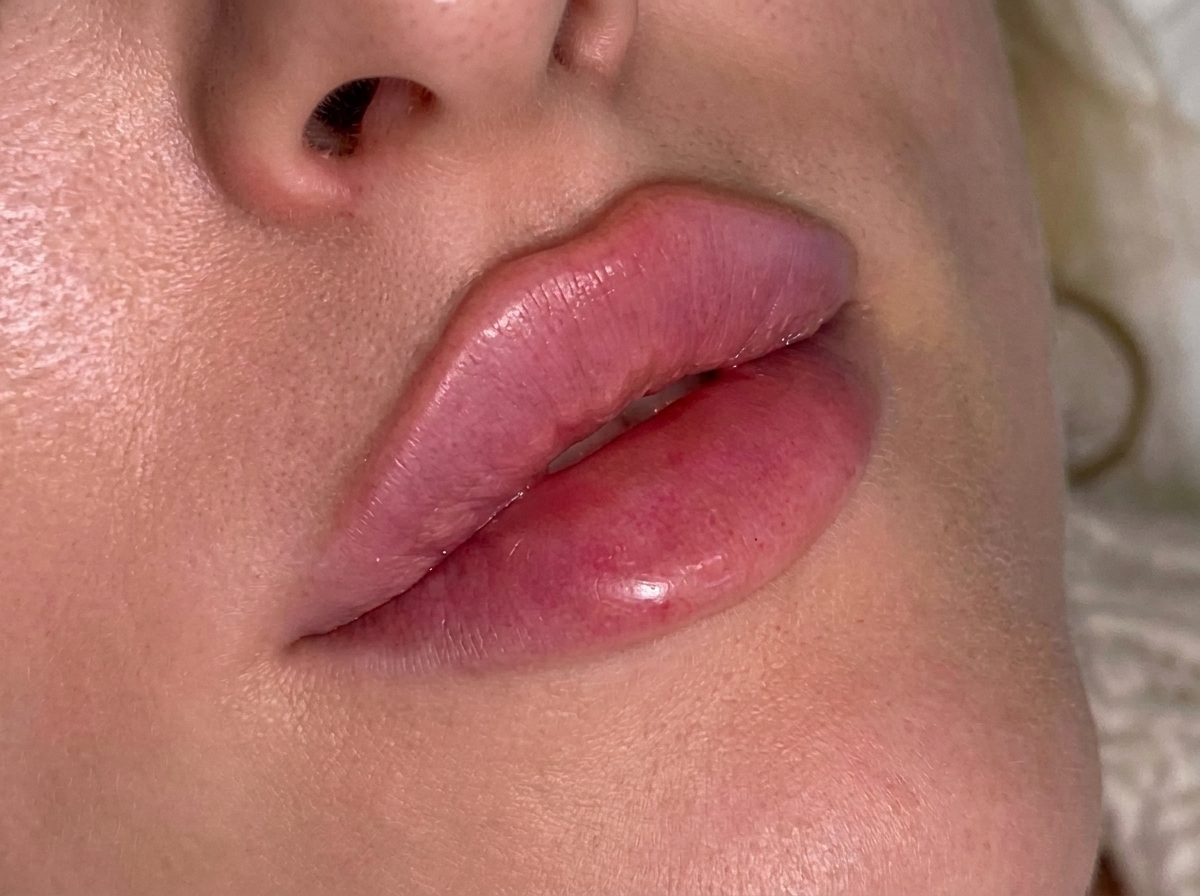 Filler à Tizi Ouzou - Soin esthétique MEL'GLOW